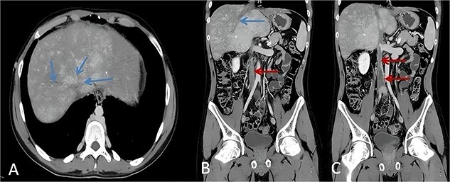 A rare case of Behçet's disease complicated by Budd-Chiari syndrome and perforated duodenal ulcers in a young male.