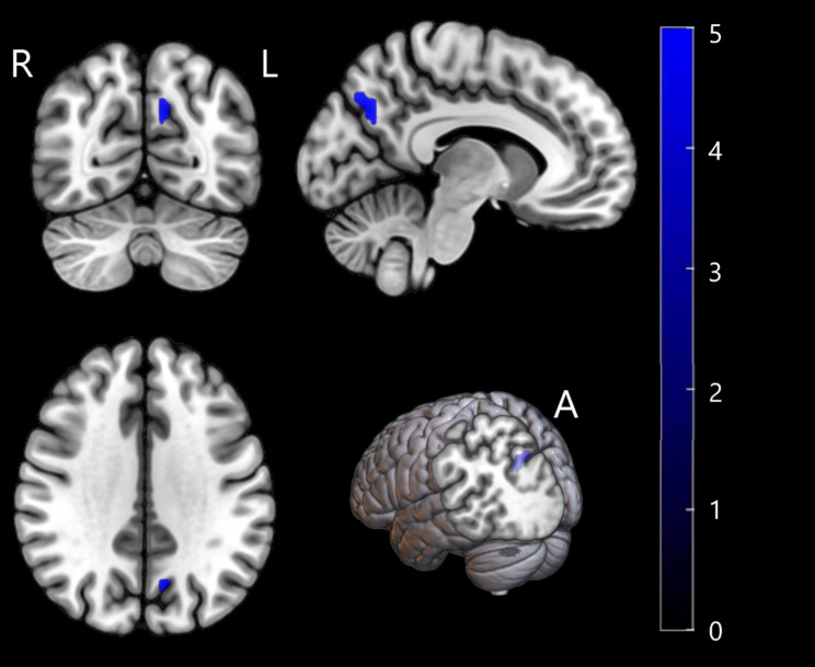 Differences of regional homogeneity and cognitive function between psychotic depression and drug-naïve schizophrenia.