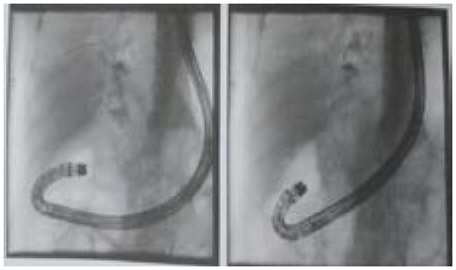Post Cholecystectomy Choledochoduodenal Fistula: A Case Report.