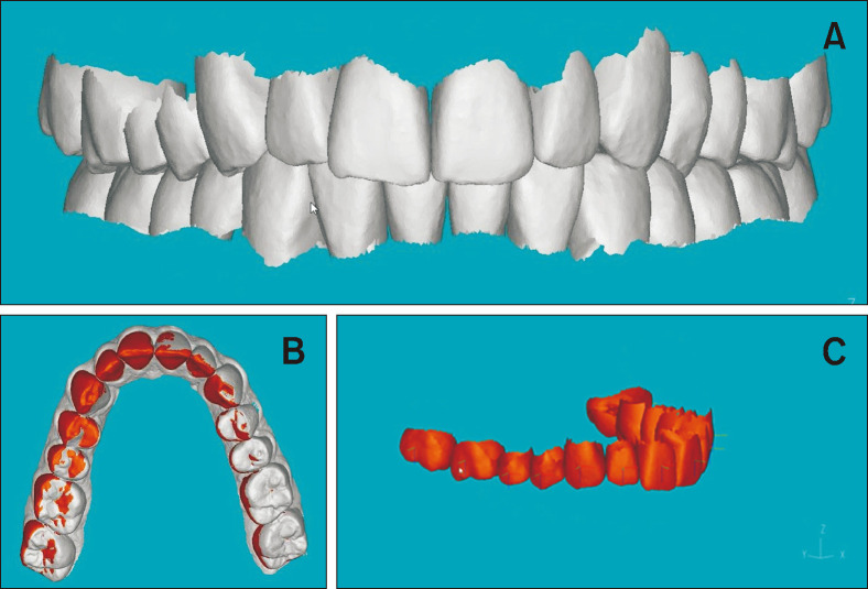 Comparison of the predicted and achieved labiolingual inclinations of the maxillary central incisors in adult Class II division 2 malocclusions treated with clear aligners.
