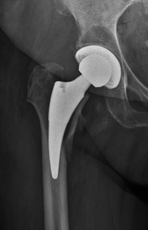 Is there a difference in pelvic and femoral morphology in early periprosthetic femoral fracture in cementless short stem total hip arthroplasty via an anterolateral approach?