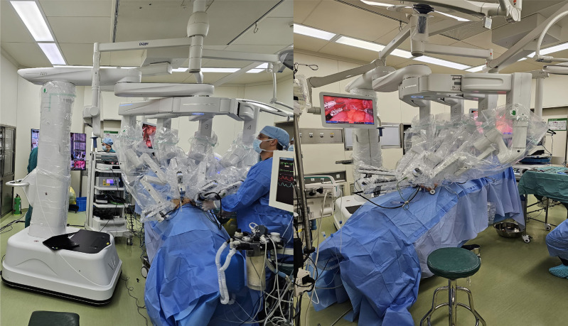 First impressions of Telesurgery robotic-assisted radical prostatectomy using the Edge medical robotic platform.