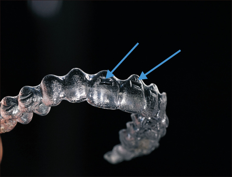 Comparison of the predicted and achieved labiolingual inclinations of the maxillary central incisors in adult Class II division 2 malocclusions treated with clear aligners.