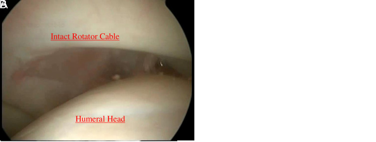 Outcomes of repaired and intact rotator cable in large posterosuperior rotator cuff ruptures.