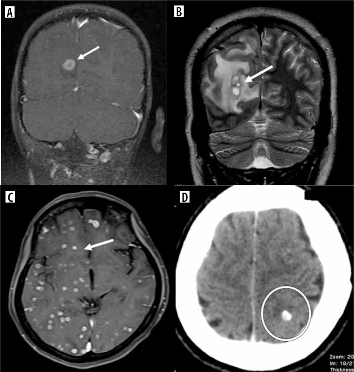 Neurocysticercosis: unwinding the radiological conundrum.