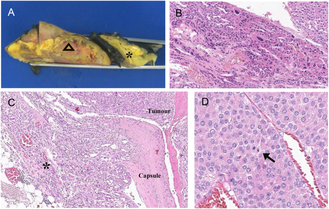 Extra-adrenal adrenocortical cancer associated with multiple endocrine neoplasia type 1.