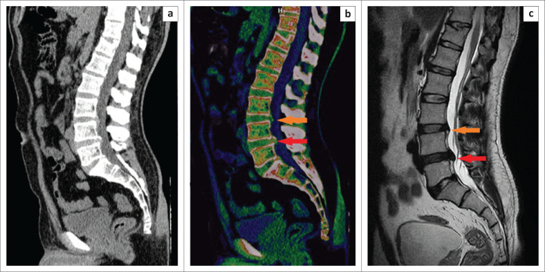Diagnostic performance of dual-energy CT with electron-density reconstruction for lumbar disc herniation.