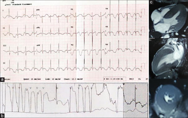Pheochromocytoma presenting with recurrent syncope, prolonged QT interval and macroscopic T-wave alternans.