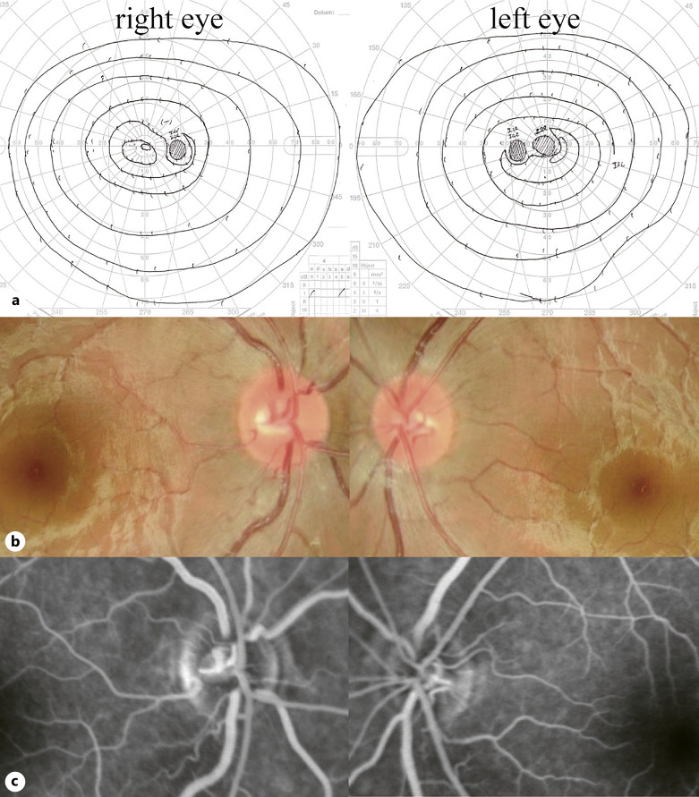 Leber Hereditary Optic Neuropathy "Plus" with the m.14487 T>C Mutation as the Causality of Hemidystonia: A Case Report.