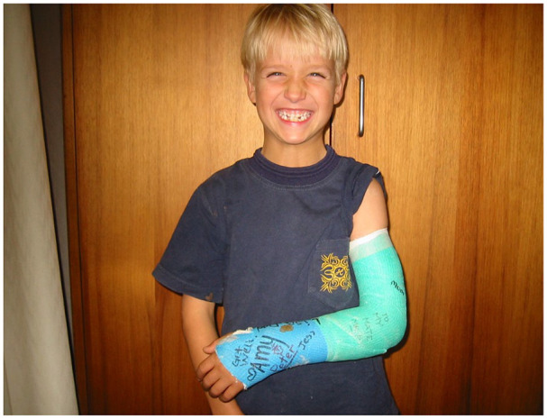 Metal implants in children.