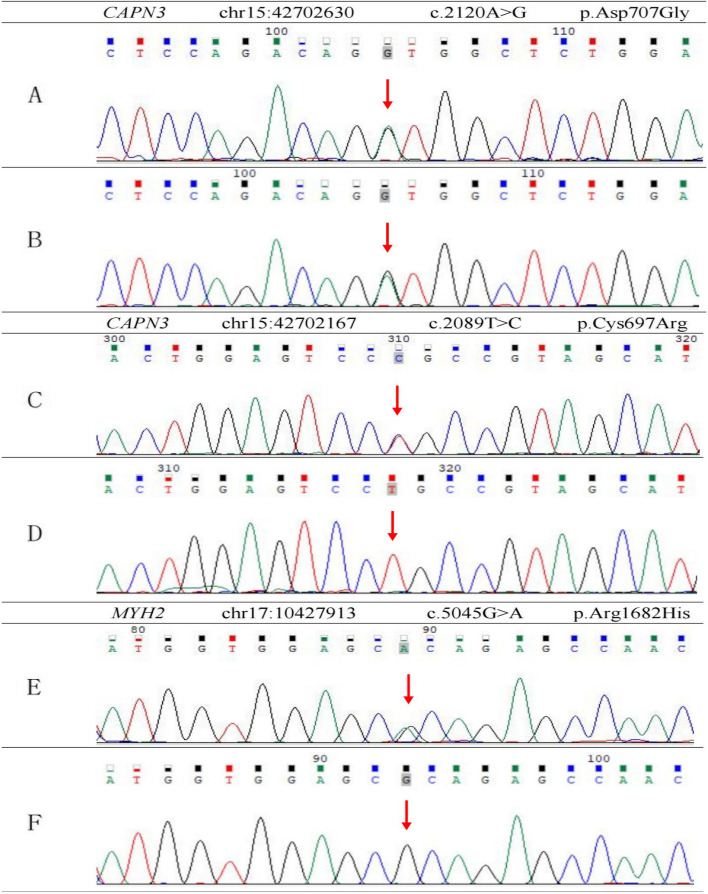 Adult late-onset limb-girdle muscular dystrophy R1/2A complicated by parathyroid adenoma and sick sinus syndrome: a case report and literature review.