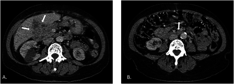 Paracoccidioidomycosis presenting as a cecal lesion mimicking cholangiocarcinoma: a case report of unusual intestinal manifestation.
