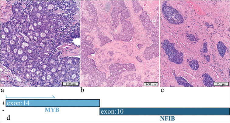 Precision medicine for patients with salivary gland neoplasms: Determining the feasibility of implementing a next-generation sequencing-based RNA assay in a hospital laboratory.