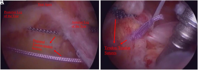 Outcomes of repaired and intact rotator cable in large posterosuperior rotator cuff ruptures.