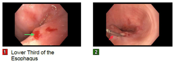 Dieulafoy's Lesion in the Esophagus Causing Gastrointestinal Bleeding: A Concise Review.