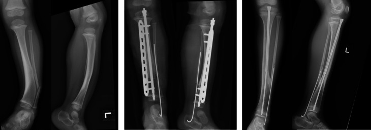 A good index surgery for congenital pseudarthrosis of the tibia minimizes complications following surgery.