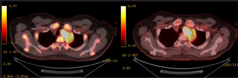Unexpected Mediastinal Mass Etiology in B-Acute Lymphoblastic Leukemia.