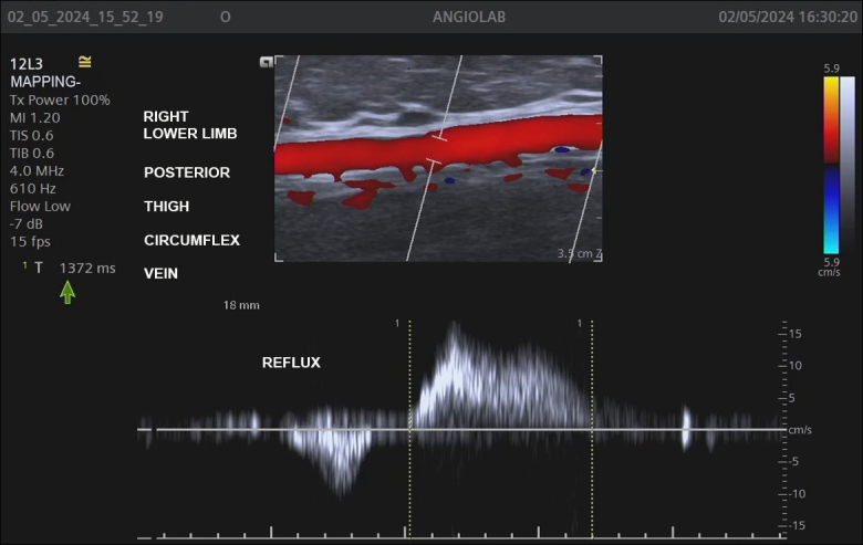 The role of the giacomini vein in preoperative mapping of lower limb varicose veins.