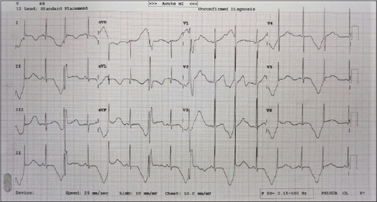 Pheochromocytoma presenting with recurrent syncope, prolonged QT interval and macroscopic T-wave alternans.