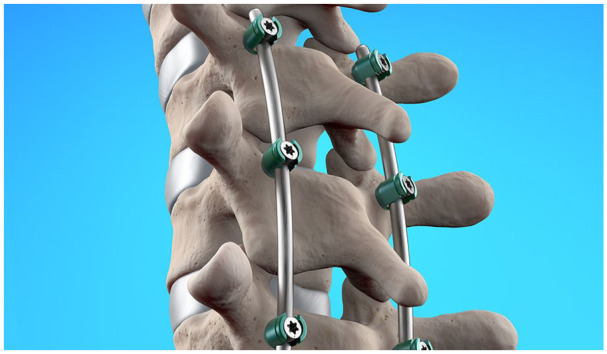 Metal implants in children.