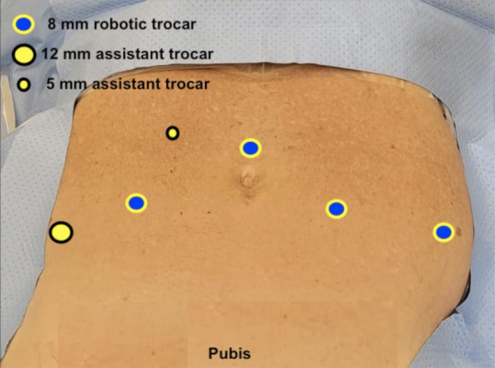 First impressions of Telesurgery robotic-assisted radical prostatectomy using the Edge medical robotic platform.