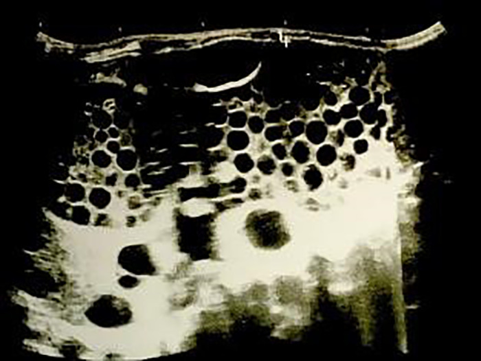 Disseminated Abdominal Cystic Echinococcosis After Blunt Abdominal Trauma: A Case Report.