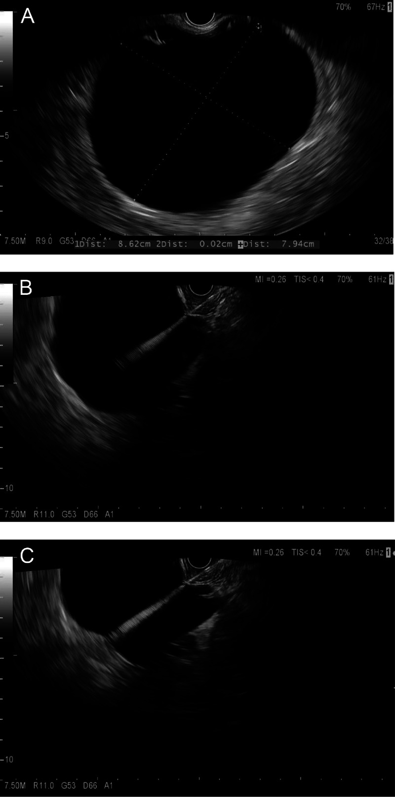 Value of EUS-guided through-the-needle biopsy in the diagnosis of pancreatic cystic neoplasms: An 8-year experience.