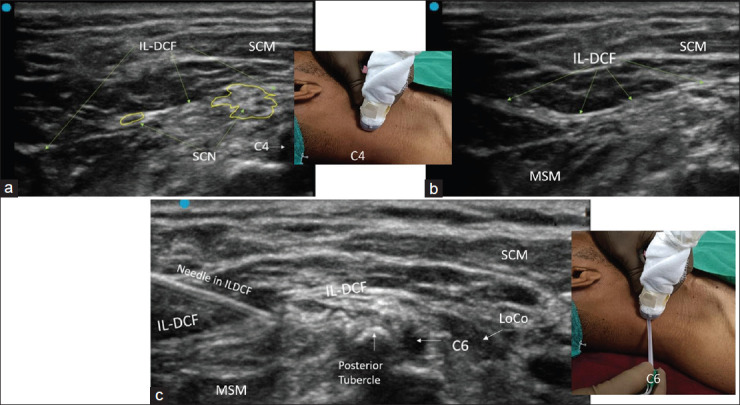 The Investing Layer of the Deep Cervical Fascia: An Alternative Site for Ultrasound-guided Supraclavicular Nerve Block - A Cadaveric Anatomical Study.