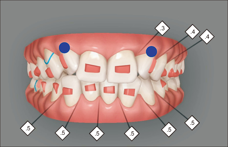 Comparison of the predicted and achieved labiolingual inclinations of the maxillary central incisors in adult Class II division 2 malocclusions treated with clear aligners.
