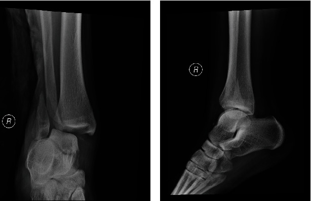 Surgeon-Administered Ultrasound-Guided Regional Anesthesia in Fixation of Distal Fibula Fracture.