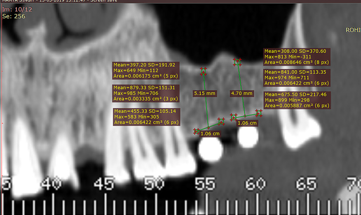 A comparative study on bone density before and after implant placement using osseodensification technique: a clinical evaluation.