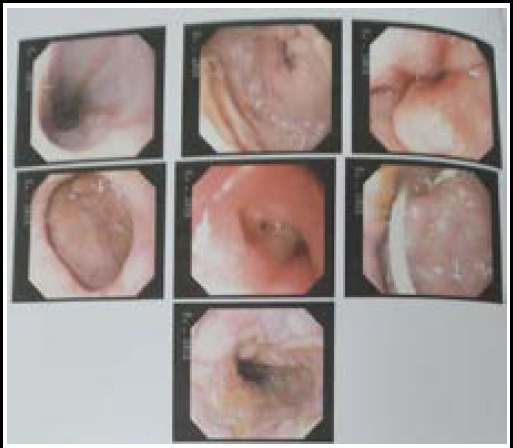 Post Cholecystectomy Choledochoduodenal Fistula: A Case Report.
