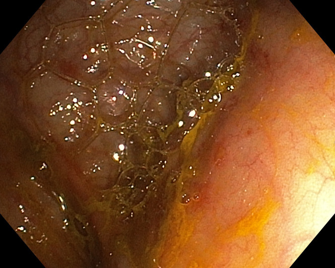 Unraveling the Mysteries of Autoimmune Gastritis.