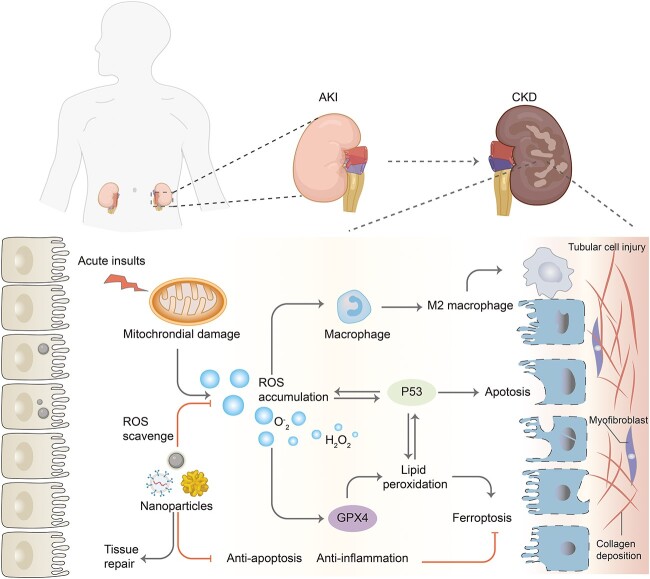 Nanomedicine embraces the treatment and prevention of acute kidney injury to chronic kidney disease transition: evidence, challenges, and opportunities.
