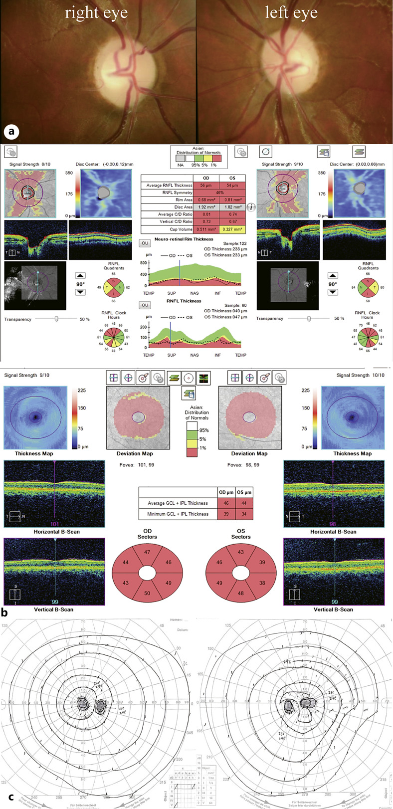 Leber Hereditary Optic Neuropathy "Plus" with the m.14487 T>C Mutation as the Causality of Hemidystonia: A Case Report.