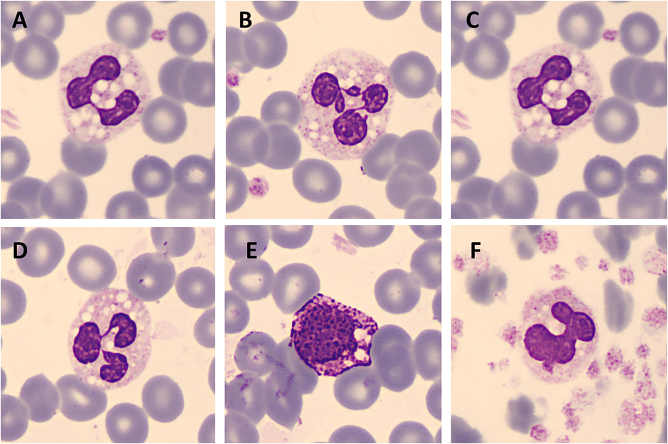 Jordans' anomaly in Chanarin-Dorfman syndrome.