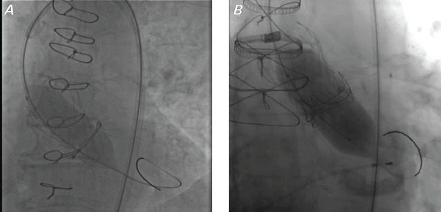 Effects of Bioprosthetic Valve Fracturing on Valve-in-Valve Transcatheter Aortic Valve Implantation Transvalvular Gradients.