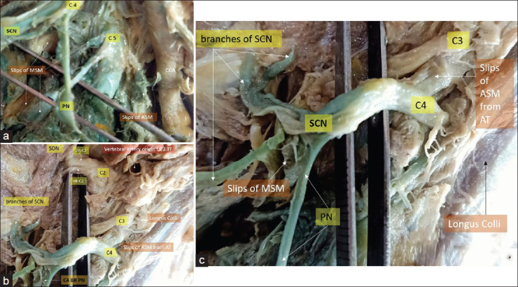 The Investing Layer of the Deep Cervical Fascia: An Alternative Site for Ultrasound-guided Supraclavicular Nerve Block - A Cadaveric Anatomical Study.