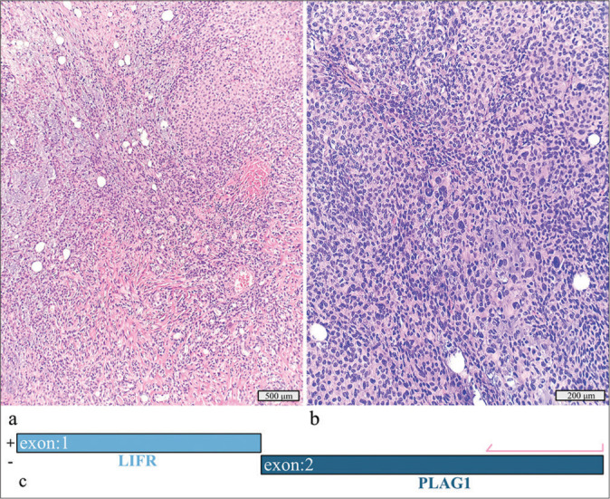 Precision medicine for patients with salivary gland neoplasms: Determining the feasibility of implementing a next-generation sequencing-based RNA assay in a hospital laboratory.
