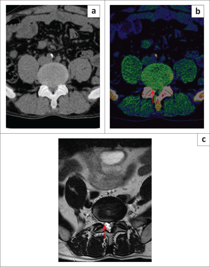 Diagnostic performance of dual-energy CT with electron-density reconstruction for lumbar disc herniation.