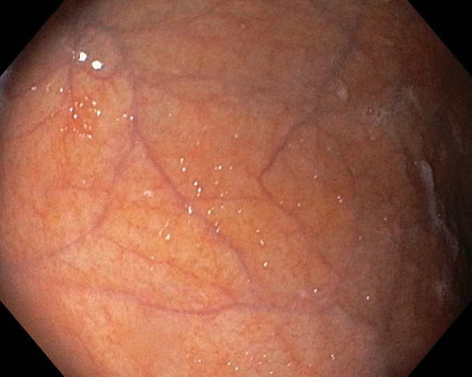 Unraveling the Mysteries of Autoimmune Gastritis.
