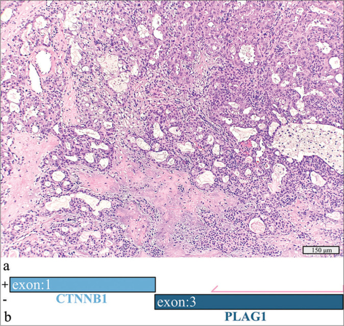 Precision medicine for patients with salivary gland neoplasms: Determining the feasibility of implementing a next-generation sequencing-based RNA assay in a hospital laboratory.