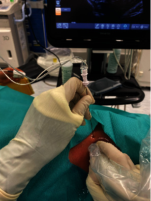 Surgeon-Administered Ultrasound-Guided Regional Anesthesia in Fixation of Distal Fibula Fracture.