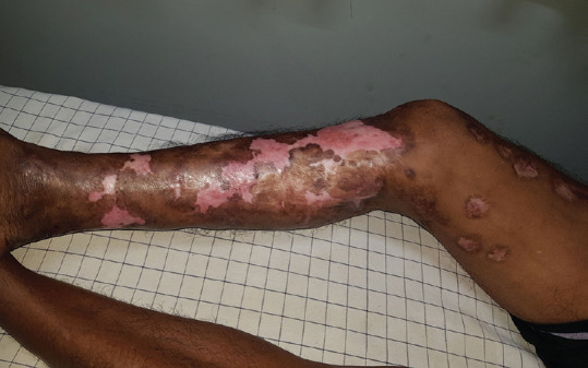 Chromoblastomycosis is curable with DAT therapy (debulking, intralesional amphotericin B, oral terbinafine); case series of 16 patients.