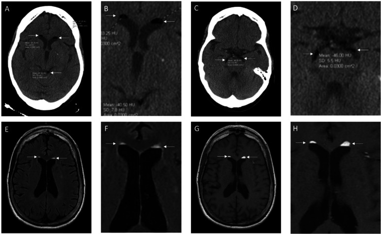 Fat droplets in the cerebrospinal fluid (CSF) spaces of the brain.