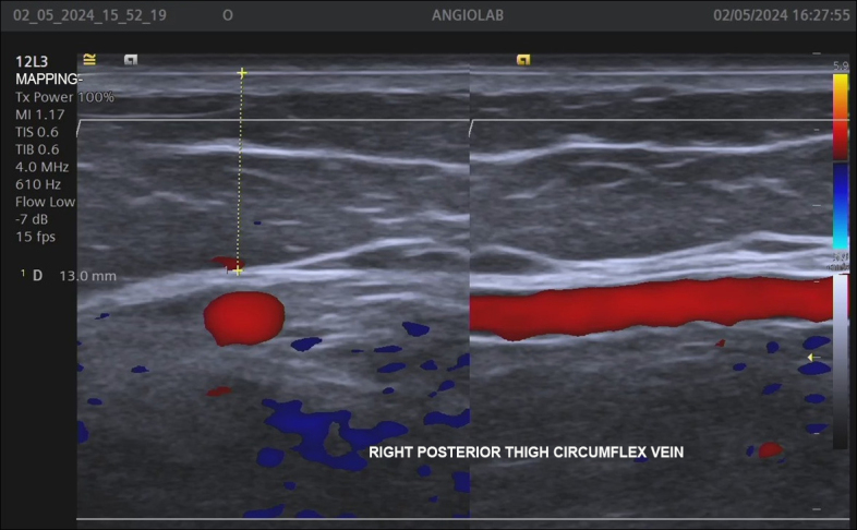 The role of the giacomini vein in preoperative mapping of lower limb varicose veins.