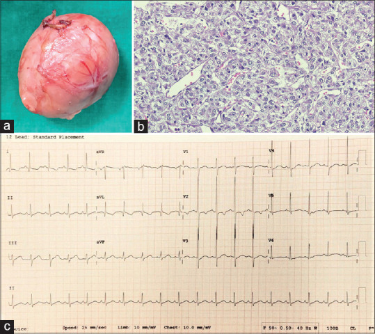 Pheochromocytoma presenting with recurrent syncope, prolonged QT interval and macroscopic T-wave alternans.