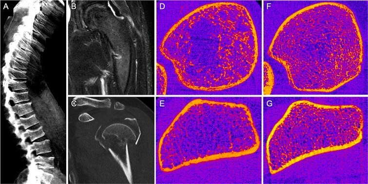In-depth clinical characterization of intravenous iron infusion-induced hypophosphatemic osteomalacia and its resolution.