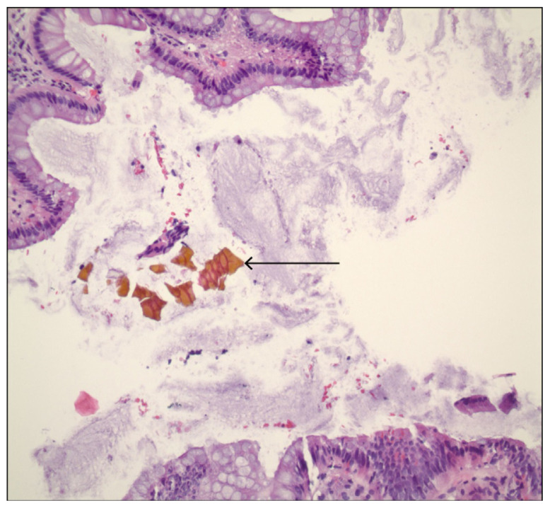 Sevelamer-induced Gastrointestinal Mucosal Injury: A Critical Review for Clinicians.