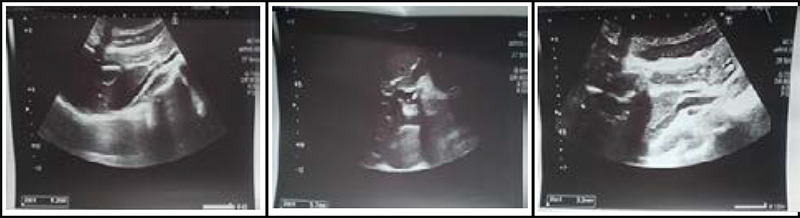Post Cholecystectomy Choledochoduodenal Fistula: A Case Report.